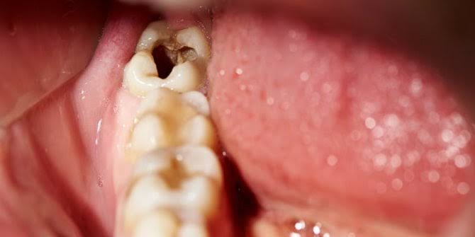 Bocah di India Punya 526 Gigi di Mulutnya